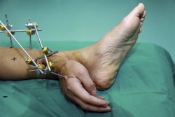 politics-war:  Xiao Wei’s severed right hand is seen attached to his ankle before the reattachment surgery at Xiangya Hospital in Changsha, Hunan province, on Dec. 4, 2013. Xiao Wei lost his right hand in an accident in the factory where he worked but