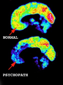 astro-surgeon:  One thing that Schizoids and Psychopaths have in common is very little activity in the limbic ‘emotional’ part of the brain.   am i the only one that thinks the bottom picture’s lighter colors looks like a cock?