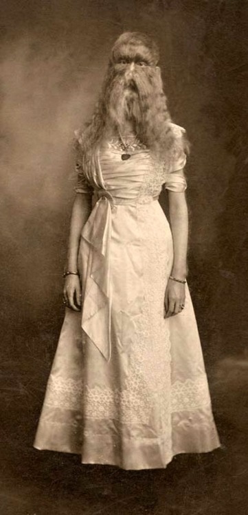 Alice Elizabeth Doherty (1887-1933) Alice E. Doherty was born in 1887 with a rare genetic mutation called “hypertrichosis”, or “werewolf syndrome”, which causes excessive body hair. She was billed as “The Minnesota Woolly