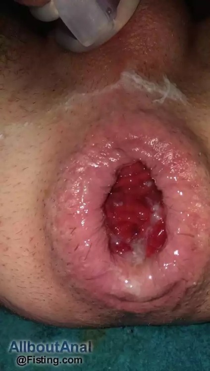 fuckedupholes: Sexy loose hole