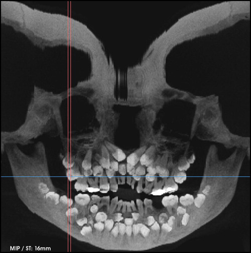 [A]n unusual case of multiple hyperodontia in a girl aged 11 years 8 months with 31 supernumerary te