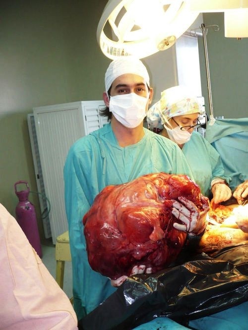 A 54 year old woman was surgically intervened at Hospital Gandulfo in Lomas de Zamora, Argentina, where a gynecological surgical team extracted a 23 kg tumor from her uterus. The weight of the tumor is comparable to the weight of a 4 year old child.