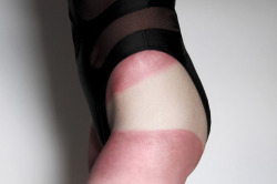 Laurenthurman-King:   Sunburn Situations, Self-Portrait, Ph. Lauren Thurman-King,