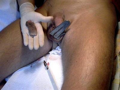 feri9091: studsnpuds: THE MOGEN CLAMP CIRCUMCISION PROCEDURE  First picture: the foreskin is retract