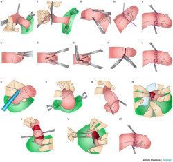 tightlycut:  eternalii-famishiis:  The doctor who cut off my foreskin for my wife used the sleeve resection method shown here in C. He decided to take away about half my inner skin and meticulously carved out every bit of my frenulum. While he was cutting