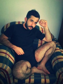 Hairy chest, legs,Beard and Mustache.