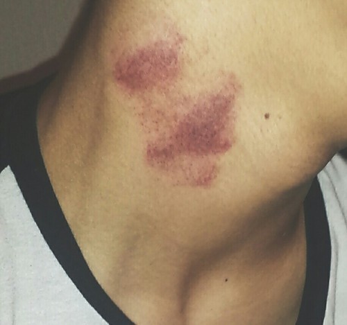 Neck on like hickey rash Random hickey