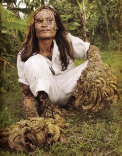 It’s Dede: The “Tree Man” Dede, Aka “Tree Man“, Is An Indonesian Fisherman