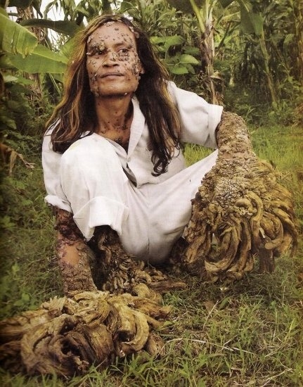 It’s Dede: The “Tree Man” Dede, aka “Tree Man“, is an Indonesian fisherman who has been slowly changing from a human into a tree… or at least that is what it appears. After cutting his knee as a teenager, Dede began to grow tree like warts