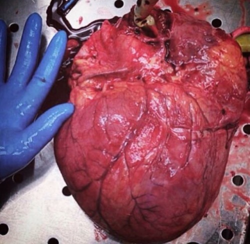 Cardiomegalia ; cardiomegaly