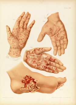 bioillustrate:  Lesions on hands and feet from skin and venereal diseases, by Prince A. Morrow, published: 1889. 