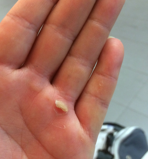 sokerijuurikas:D: i did a partial deadlift with 140kg (307lbs) and my palms opened….if ur doing ur d
