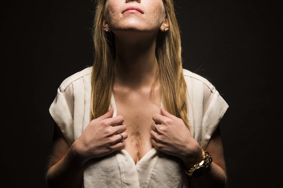 huffingtonpost:  24 Women Bare Their Scars To Reveal The Beauty In Imperfections“It’s