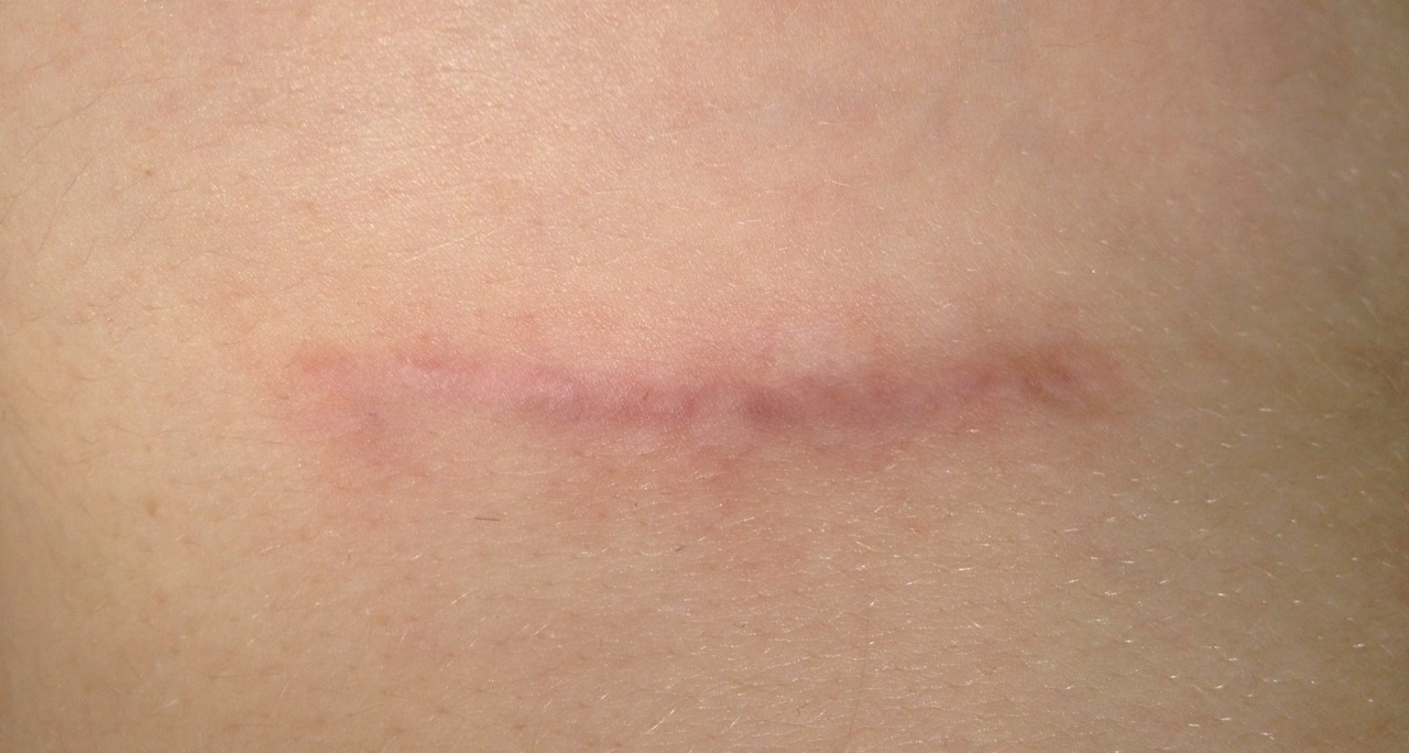 tieme-takeme:  4 Months Post-Op  Sooooo, they look really similar to last update