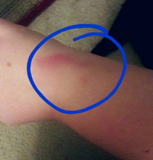 Check out this bruise I got on my wrist that I have no recollection of getting. If I was less clumsy