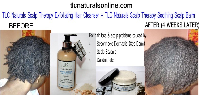yeahsexyweaves:  For people who suffer from eczema/scalp irritation, this product