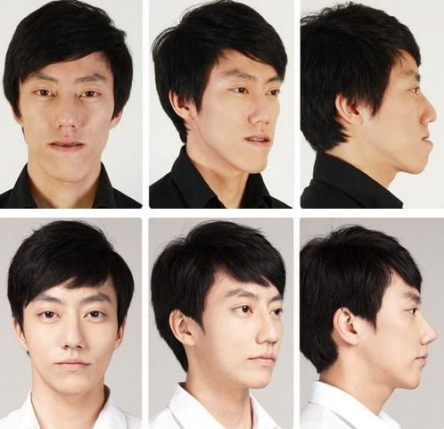 korean plastic surgery before and after jaw