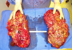 eviscerator:  Polycystic kidney disease A cystic genetic disorder of the kidneys (found with both dominant and recessive inheritance patterns). The cysts are numerous and are fluid-filled, resulting in massive enlargement of the kidneys. The disease