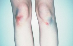 miyukimilk:  bruise