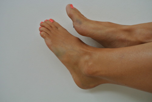 update from my broken foot. #daythree