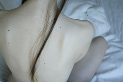 Pale skin & bruises addict.