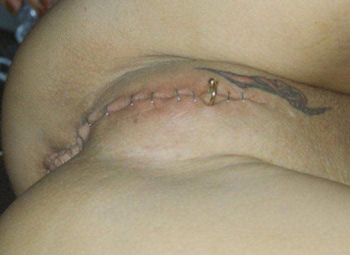 pussymodsgalore  BDSM chastity play. Pussy stapled shut. Horizontal clithood piercing