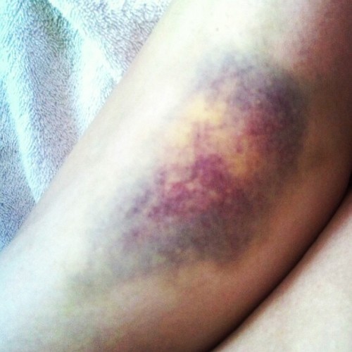 Sometimes you win some, sometimes you bruise some. See how these bruises get made this Saturday in N