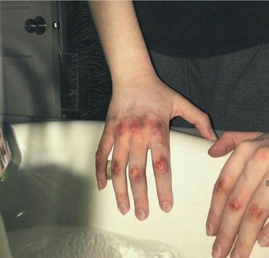#tw:-bruised-knuckles on Tumblr