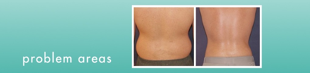 Coolsculpting results