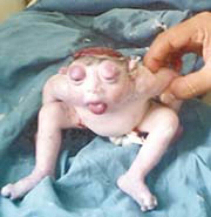 This rare bizarre condition is called Anencephaly Syndrome. The baby was born without