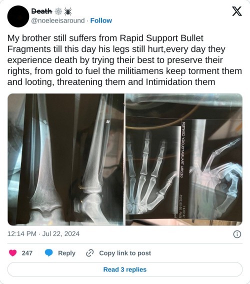 My brother still suffers from Rapid Support Bullet Fragments till this day his legs still hurt,every day they experience death by trying their best to preserve their rights, from gold to fuel the militiamens keep torment them and looting, threatening them and Intimidation them pic.twitter.com/mP43Nsn20f
— D̶e̶a̶t̶h̶ 🕸️🕷️ (@noeleeisaround) July 22, 2024