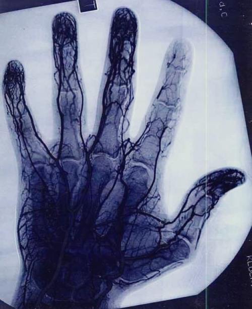 putthatazztowork:sixpenceee:Angiogram showing vascular depletion of index finger from a Yo-yo master