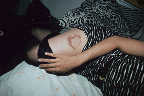 jimlovesart: Nan Goldin - Heat Shaped Bruise, NYC, 1980. 