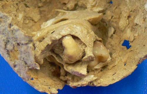 Teratoma in ancient world — archaeological findings.  In a necropolis in Spain, archaeologists have found the remains of a Roman woman who died in her 30s with a calcified tumor in her pelvis, a bone and four deformed teeth embedded within it. Two of