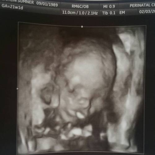 Her umbilical cord is in front of her face, but nonetheless&hellip; 3D pic of the little bear at