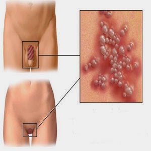 Genital herpes in women vagina