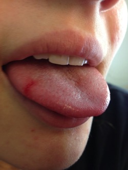 Ignore my chipped tooth please but ouch bit my tongue