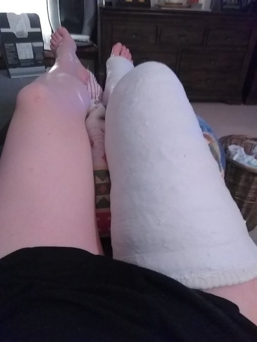 My husband’s cast my leg. Plaster is still damp. I hope you like the photo!