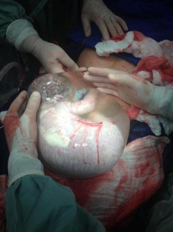 Photo of baby born via cesarean in the caul (a peek of life inside the womb)