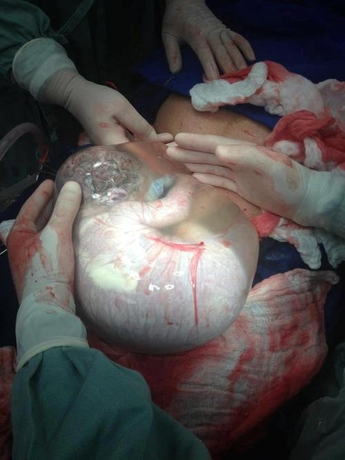 Porn photo Photo of baby born via cesarean in the caul