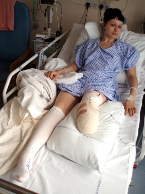 unusualpassions:  Viktoria after voluntary amputation resulting from botched surgeries.  She’s