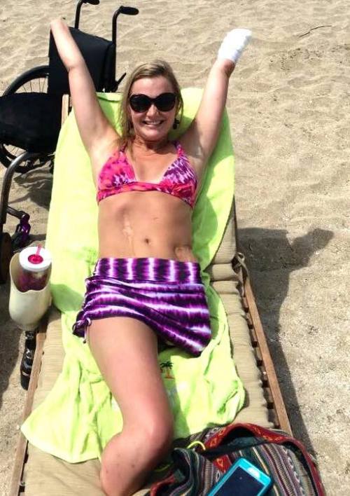 Aimee Copeland sans prostheses showing off her scars