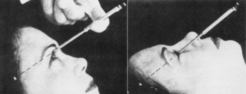 peashooter85:Dr. Walter Freeman and the Ice Pick Lobotomy,During the late 19th and early 20th centur