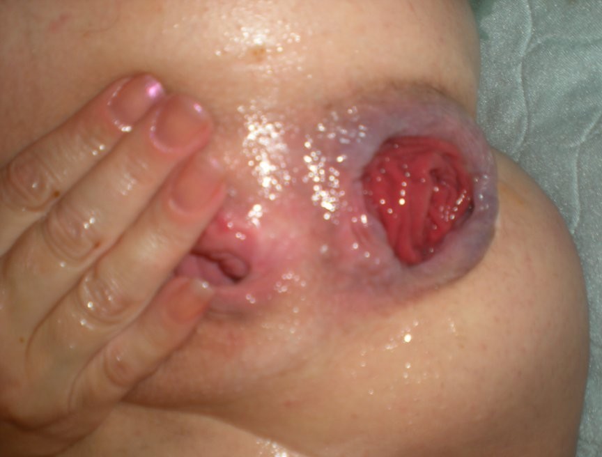 fisting-analny:  Zmasakrowany anus po fistingu
