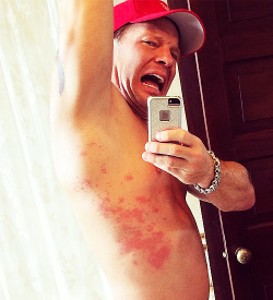 y2jbaybay:  Ever been bitten by a jelly fish? I have..... #OUCH ~ IAmJericho 