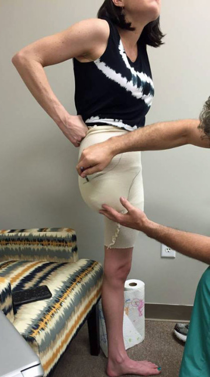 Lost leg to angiosarcoma, now getting fitted for prosthetic leg