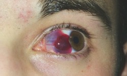 moshingxwithxmyxdemons:Cameron’s eye