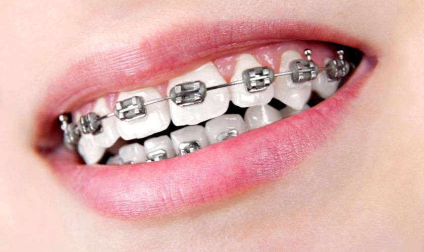 Which Orthodontic Treatment is Right for Me? - Auburn Dentist
