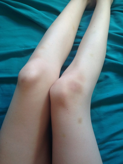 blooodelf:  I bruise so easily