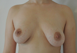 breastanxiety:  25 My uneven breasts make